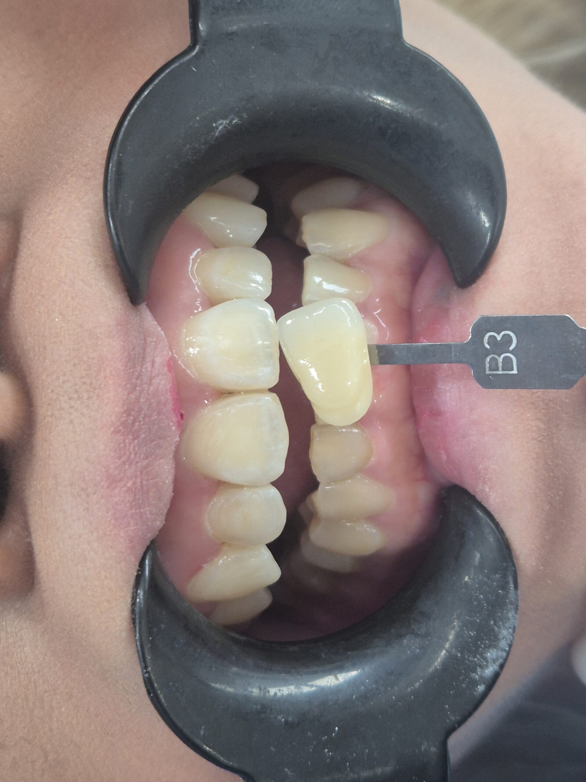 Teeth whitening treatment