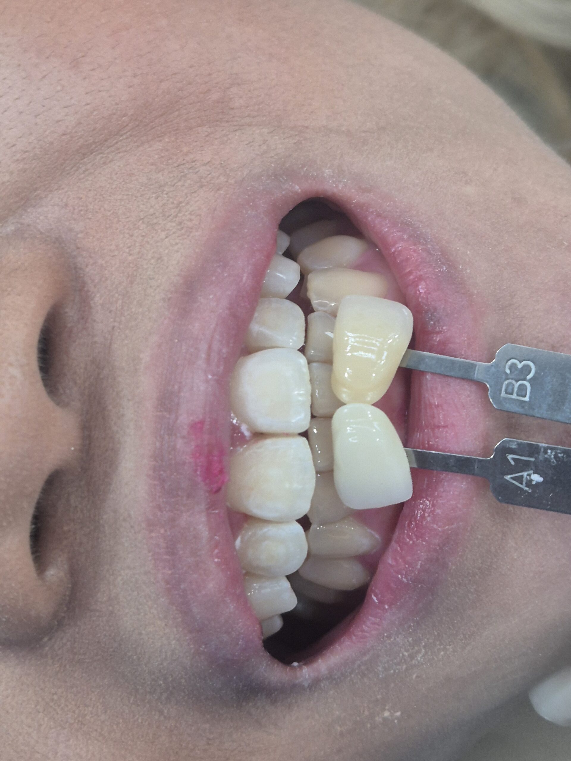 Teeth whitening treatment