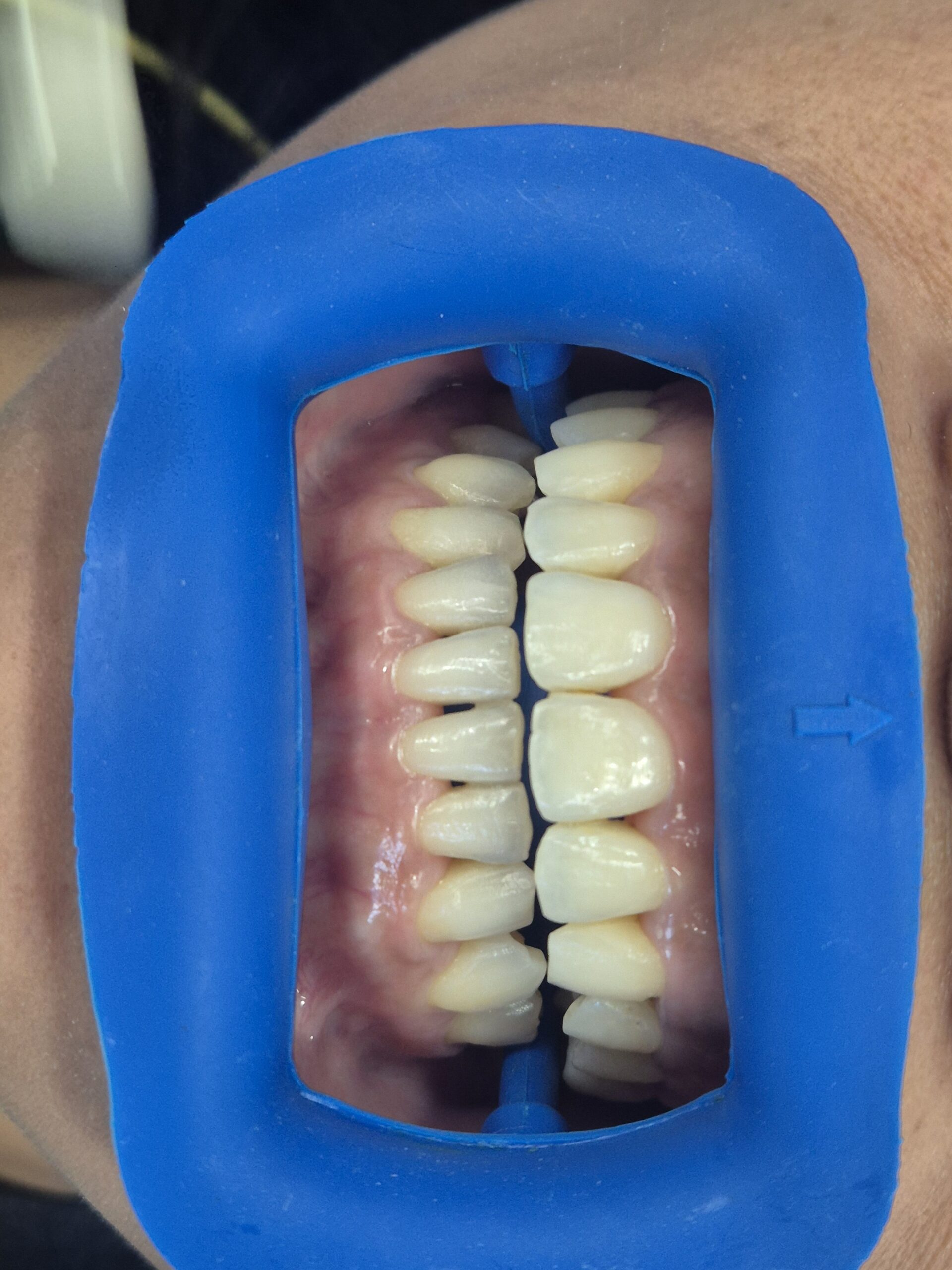 Teeth whitening treatment