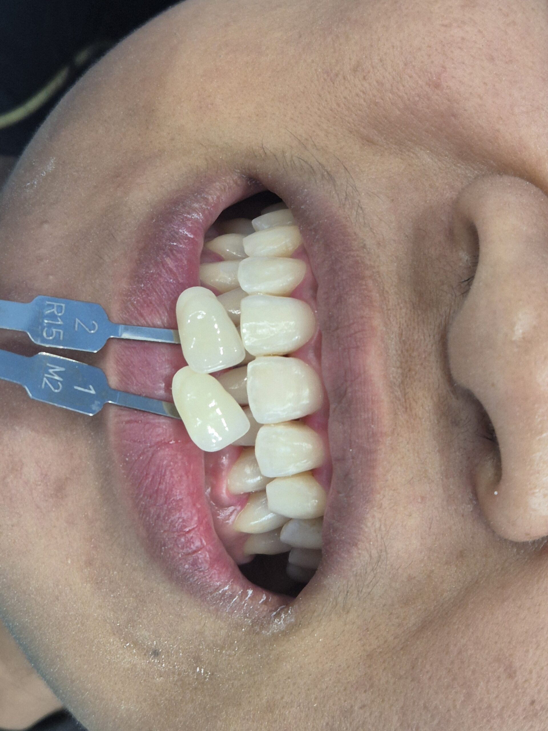 Teeth whitening treatment