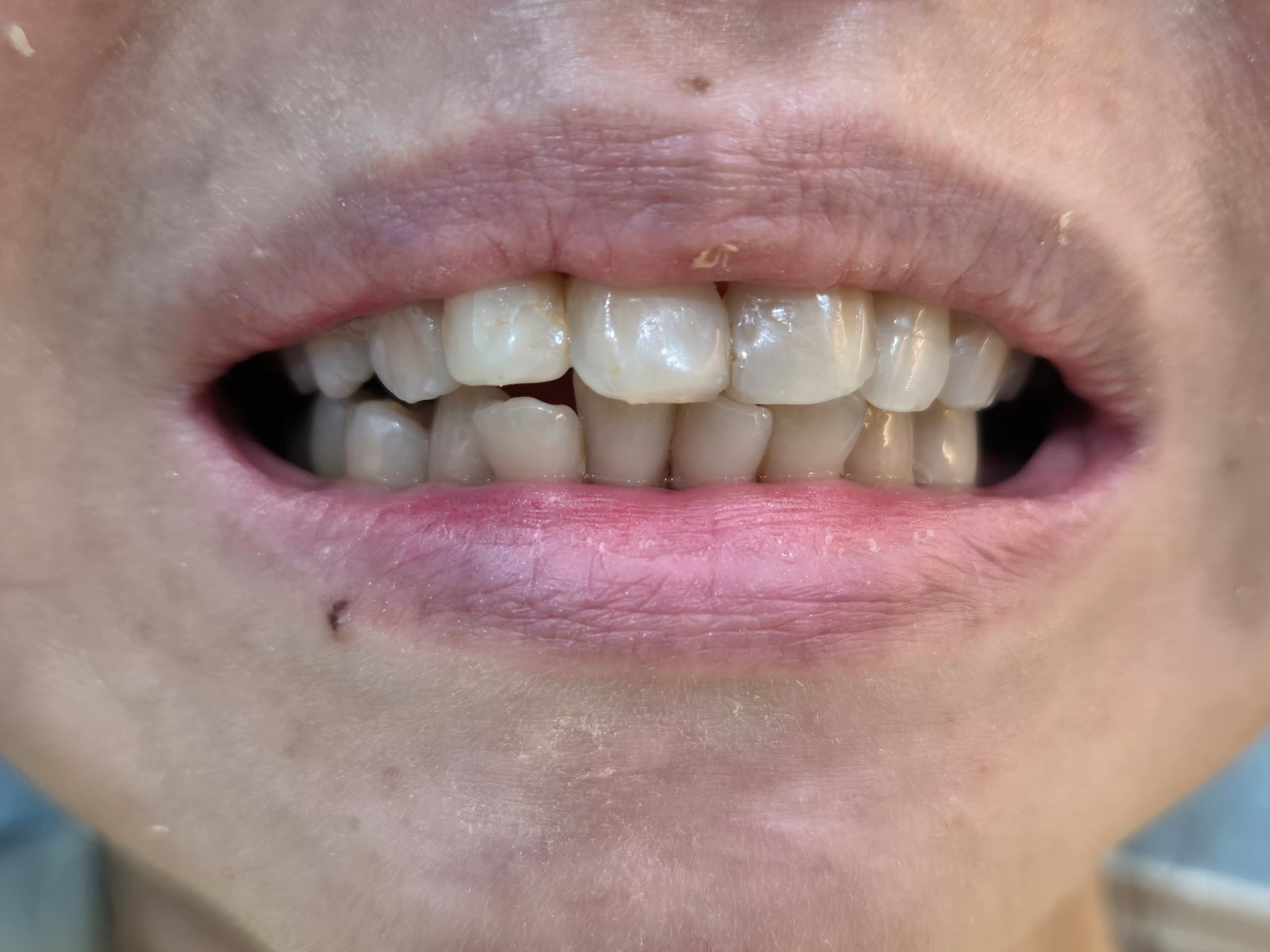 Dental veneers treatment