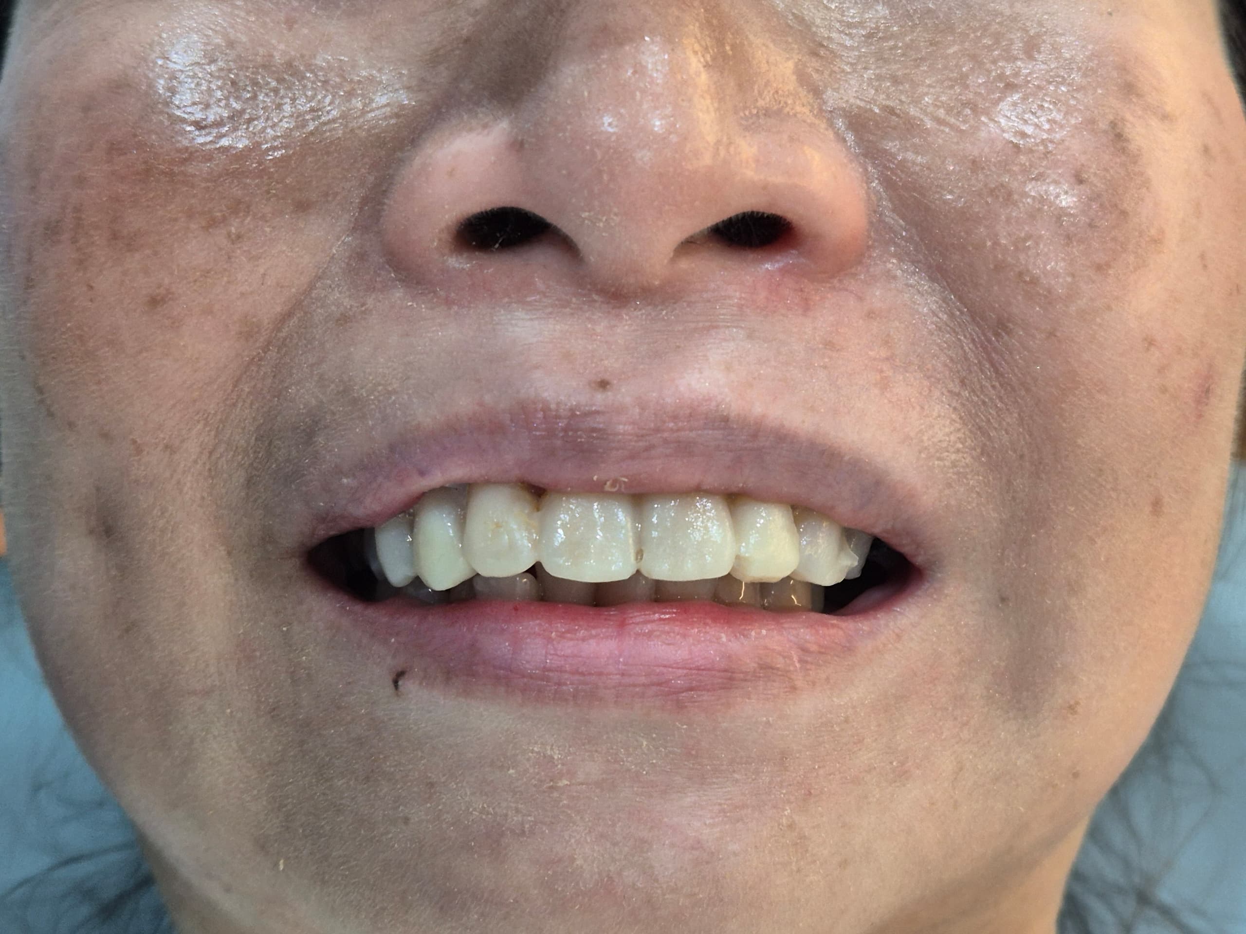 Dental veneers treatment