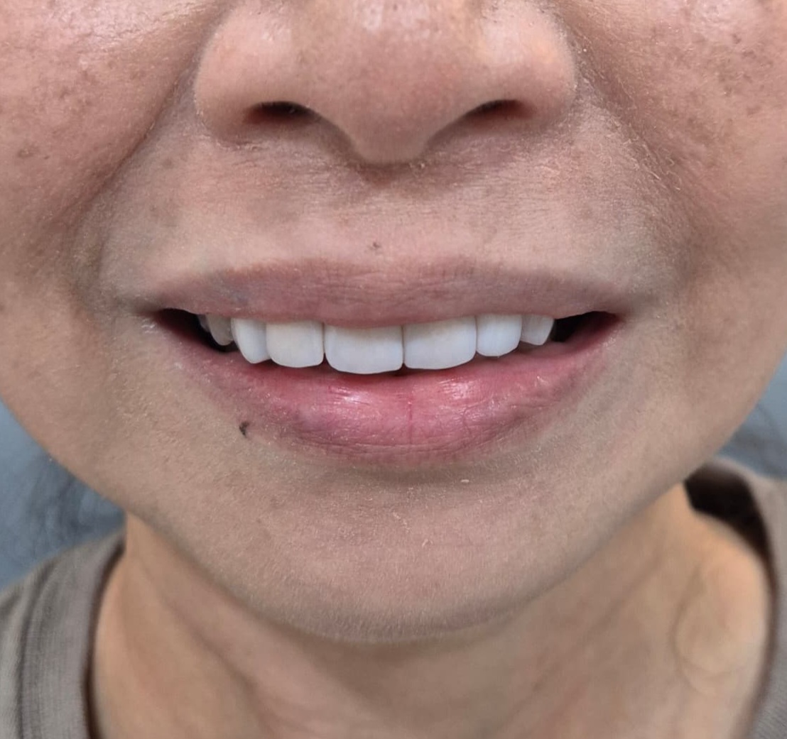 Dental veneers treatment