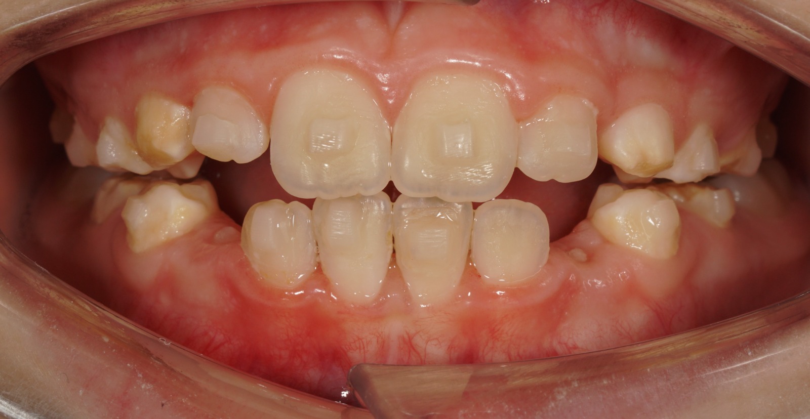 Clear aligner treatment
