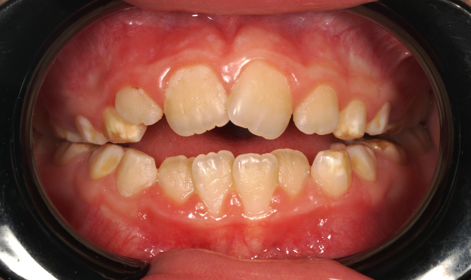 Clear aligner treatment