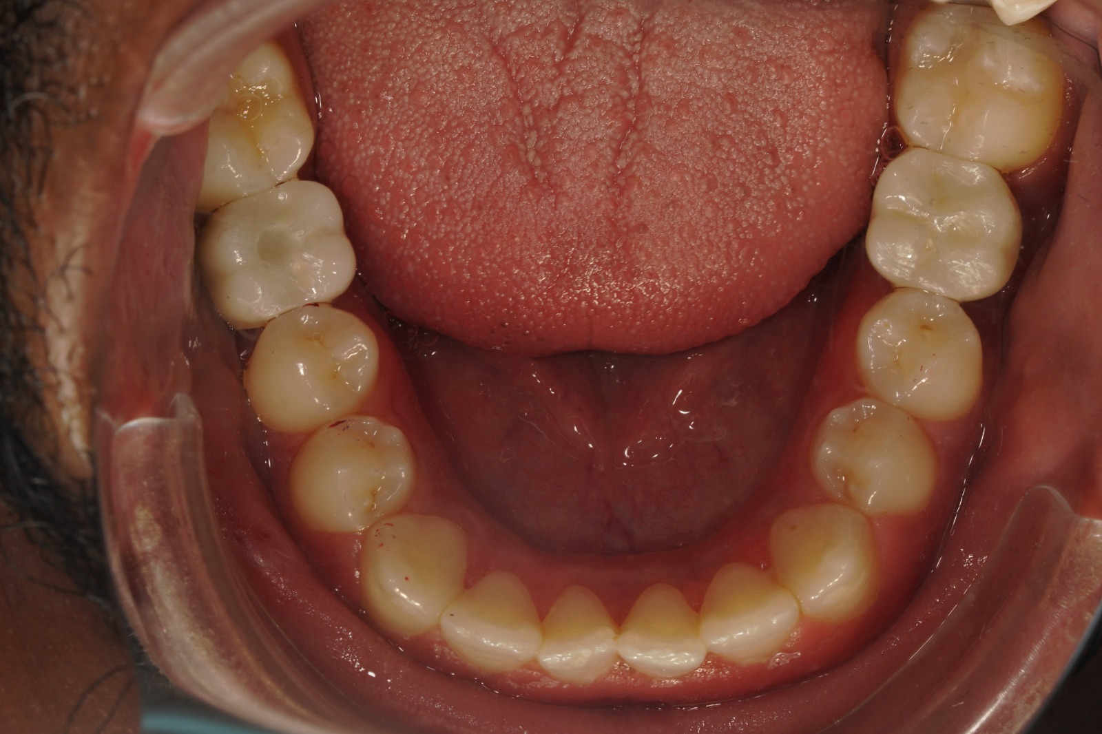 Dental implant treatment