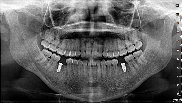 Dental implant treatment