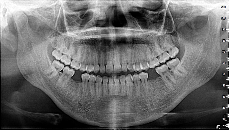 Dental implant treatment